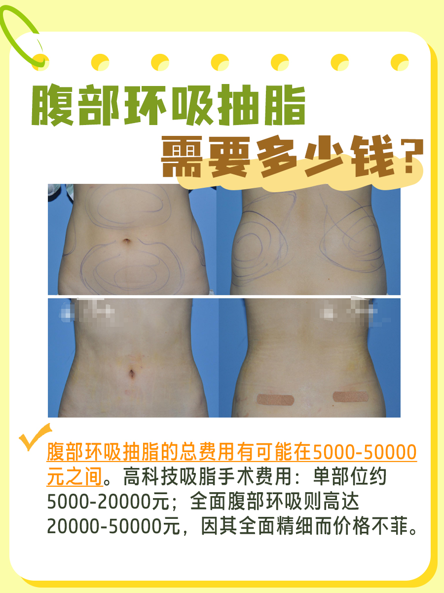 全面了解腹部环吸抽脂费用，合理规划预算！