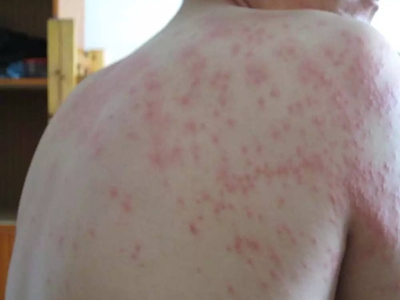 脓毒败血症疹后背长了很多红色小疙瘩图.jpg