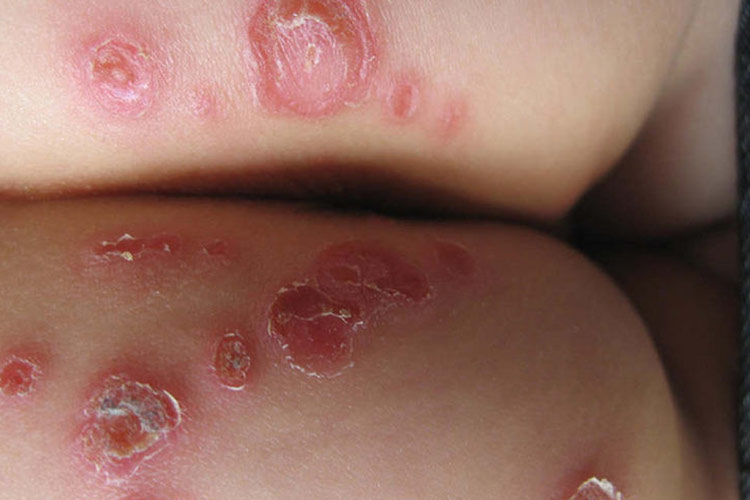 臀部脓疱疮图
