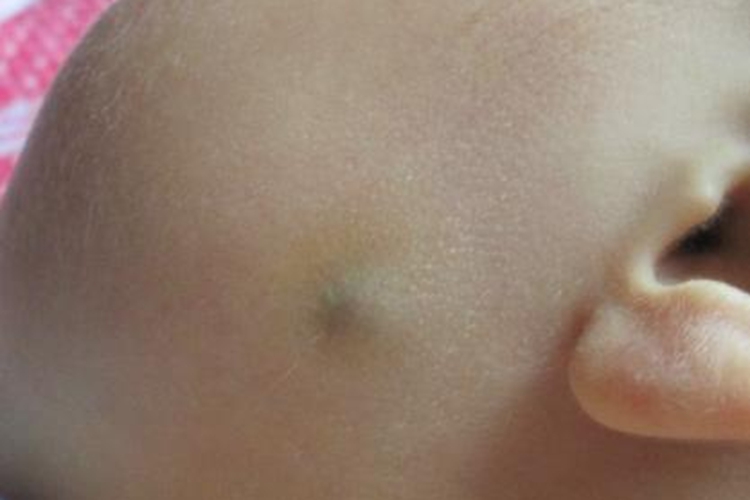 小孩脸上皮脂腺囊肿图