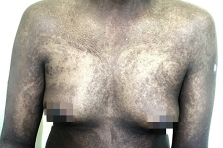 脱色素性色素失禁症胸部脱色斑图