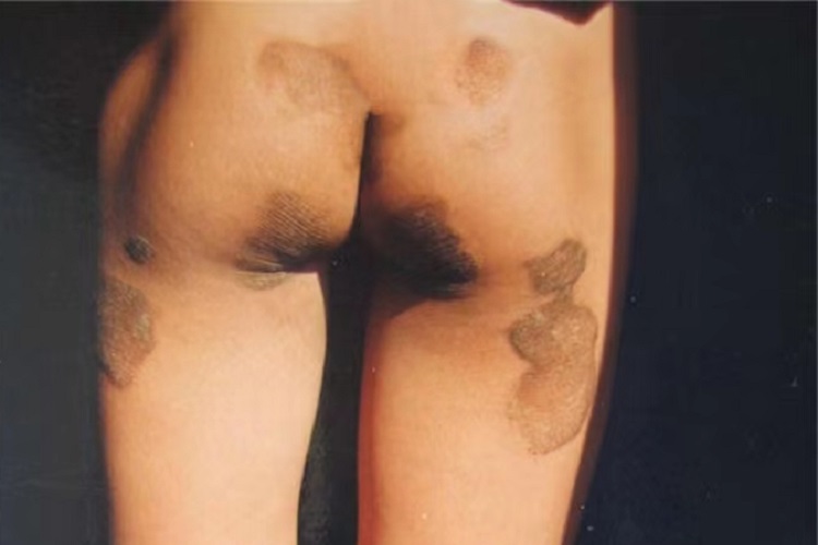 变异性红斑角化病臀部症状图