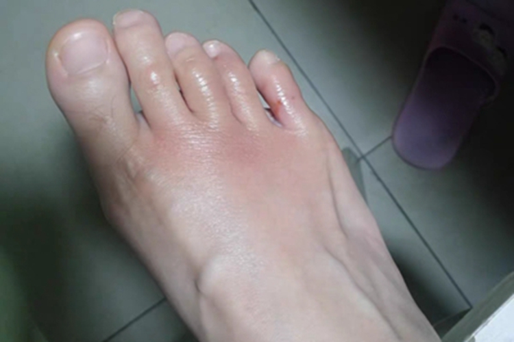 浸渍糜烂型足癣脚趾红肿图