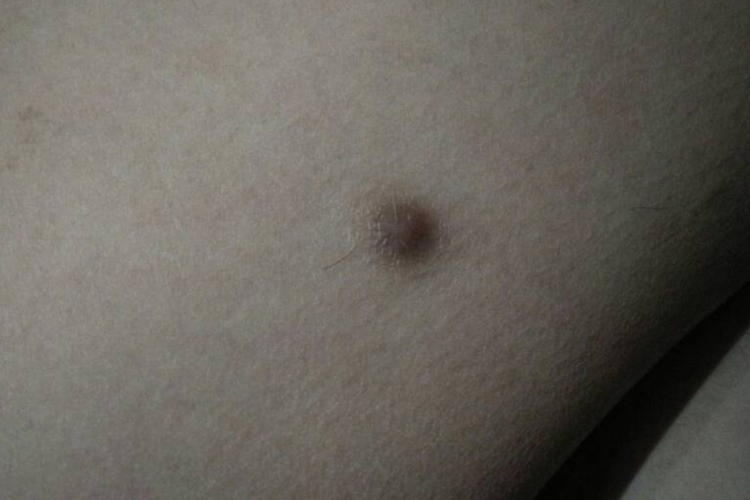 大腿黄褐色皮肤纤维瘤图