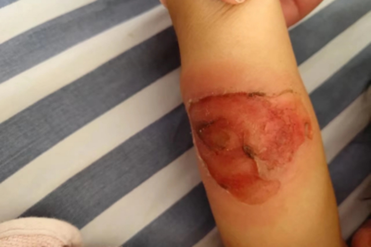 脓疱疮胳膊脱屑图 脓疱疮胳膊脱屑图