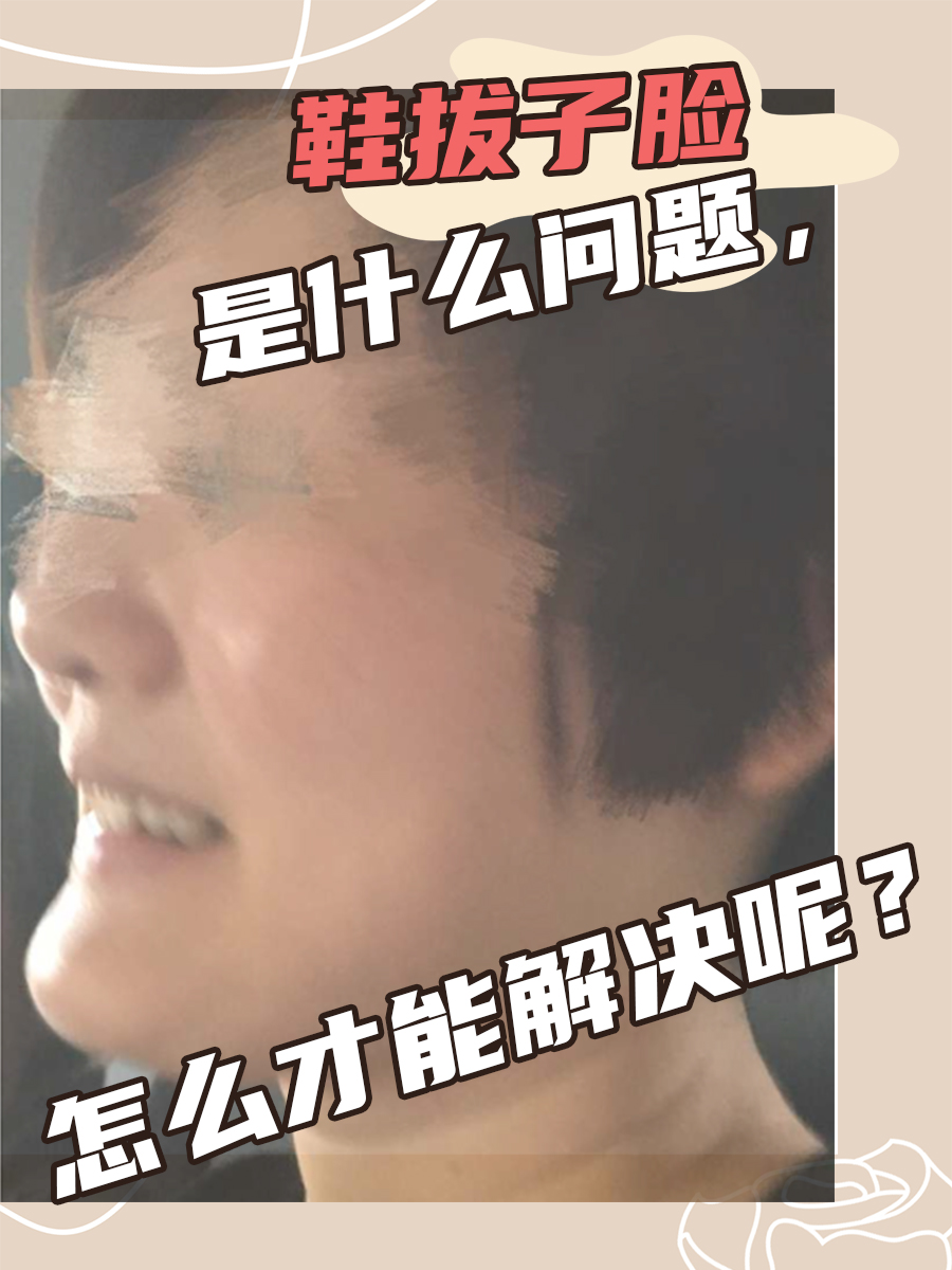 鞋拔子脸是什么问题,怎么才能解决呢?