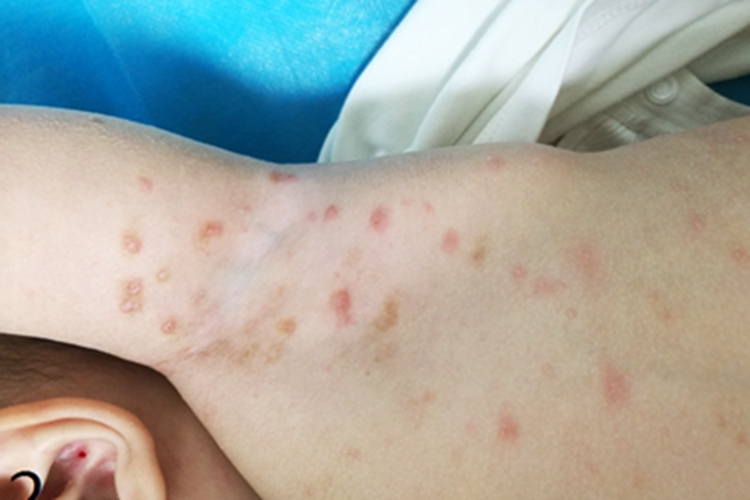 疥疮腋窝症状图 疥疮腋窝症状图