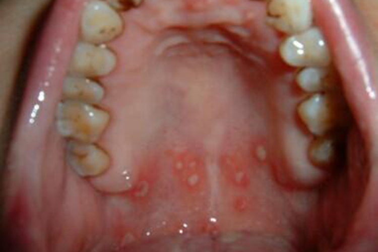 二期口腔梅毒口腔红斑图