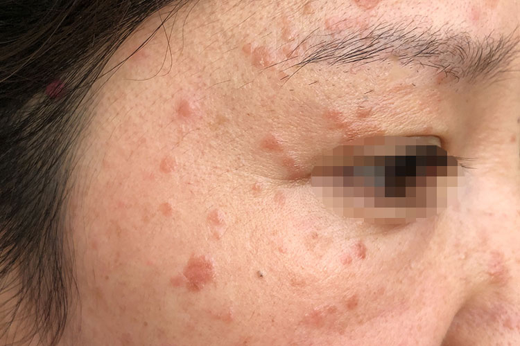 眼睛下面扁平疣图