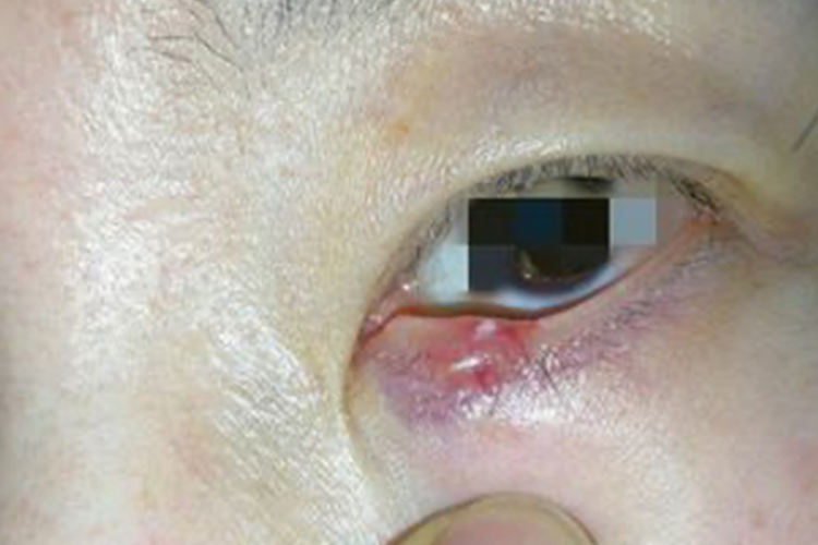 眼睑板腺堵塞症状图片