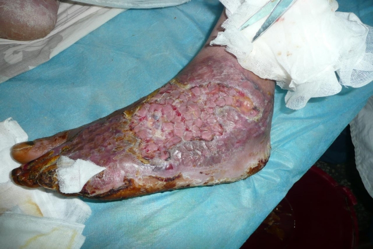 糖尿病脚部溃疡糜烂图