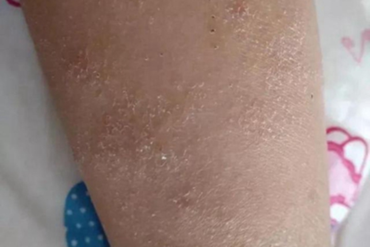 干性湿疹小腿皮肤粗糙起皮图 干性湿疹小腿皮肤粗糙起皮图