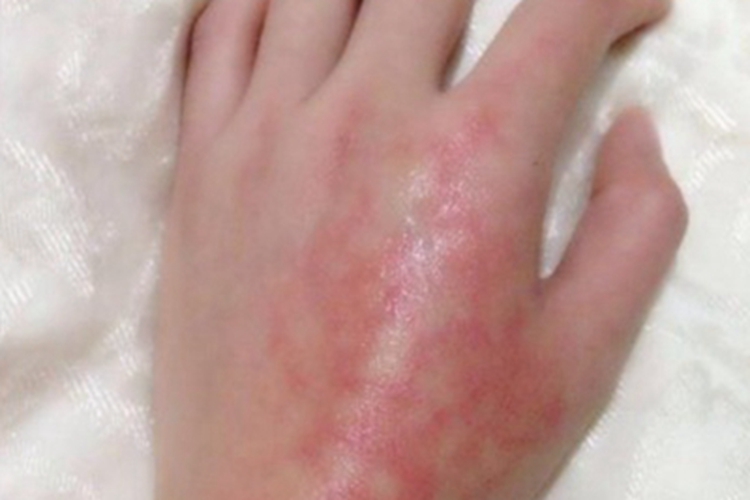 Ⅰ度烧伤手部红肿图