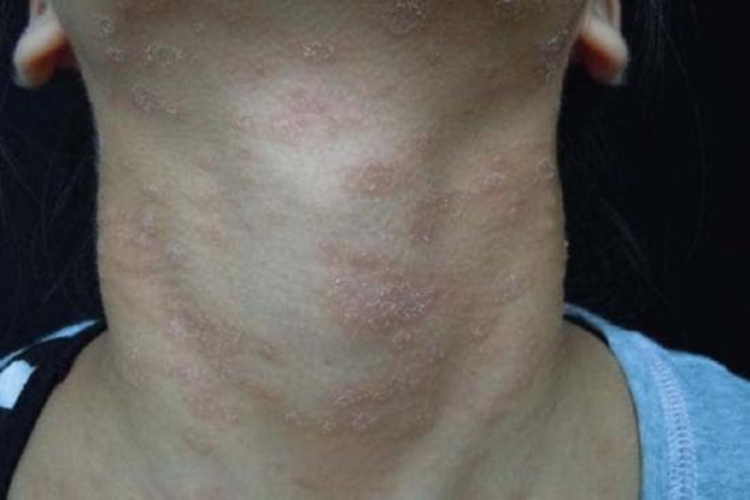 艾滋病玫瑰糠疹图 艾滋病玫瑰糠疹图