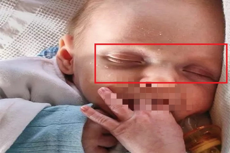 脱水眼窝凹陷图 脱水眼窝凹陷图