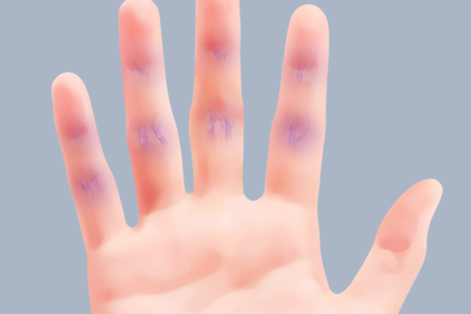 手指血管鼓起发青图 手指血管鼓起发青图