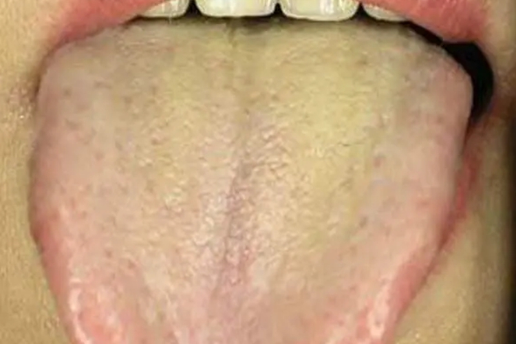 黄腻苔图 黄腻苔图