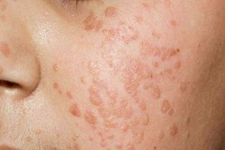 艾滋病急性期脸上皮疹图