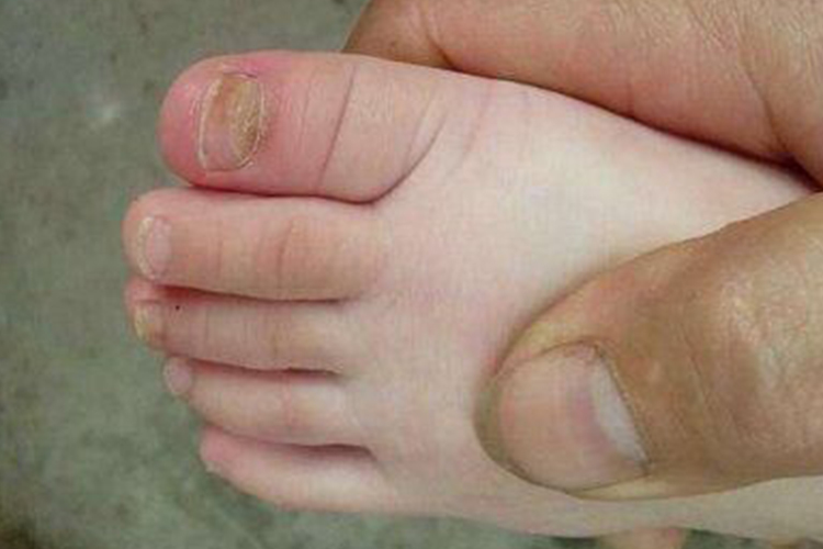 儿童灰指甲近端甲下型图