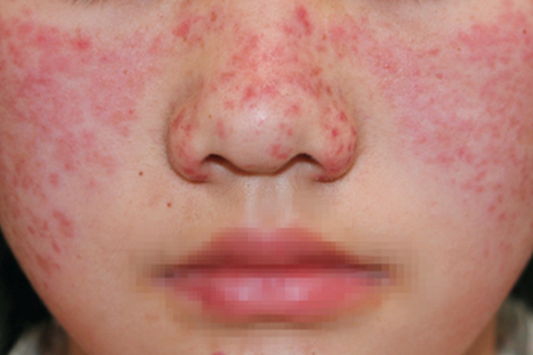 女性系统性红斑狼疮图