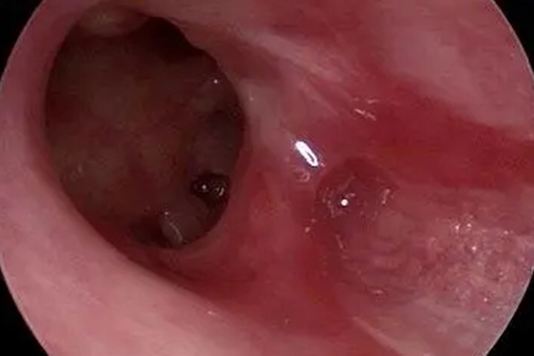 乳突炎耳镜检查图