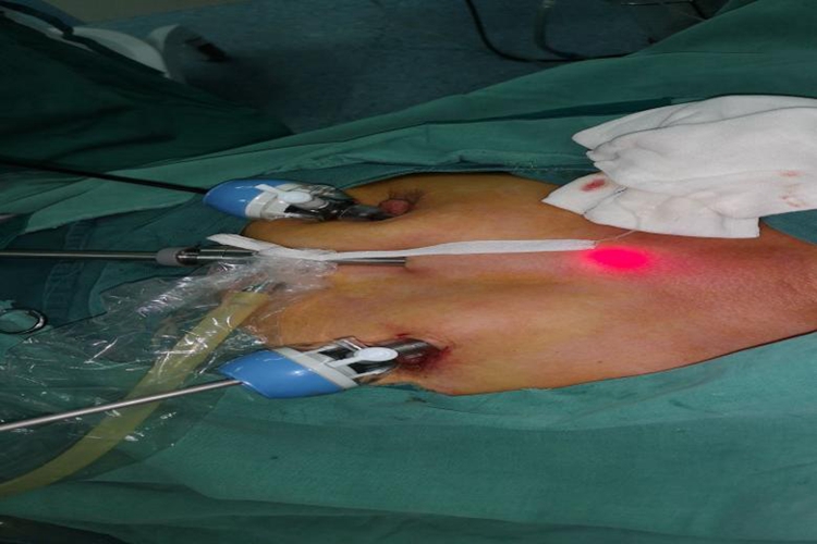 甲状腺腔镜手术乳晕径路图