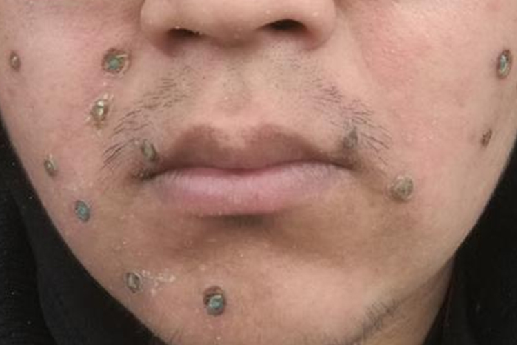 点痣正常结痂图片