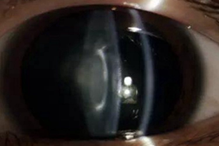 绕核性白内障症状图