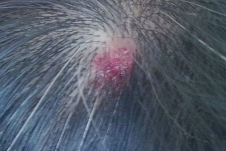 头皮脓疱糜烂性皮病头皮糜烂图