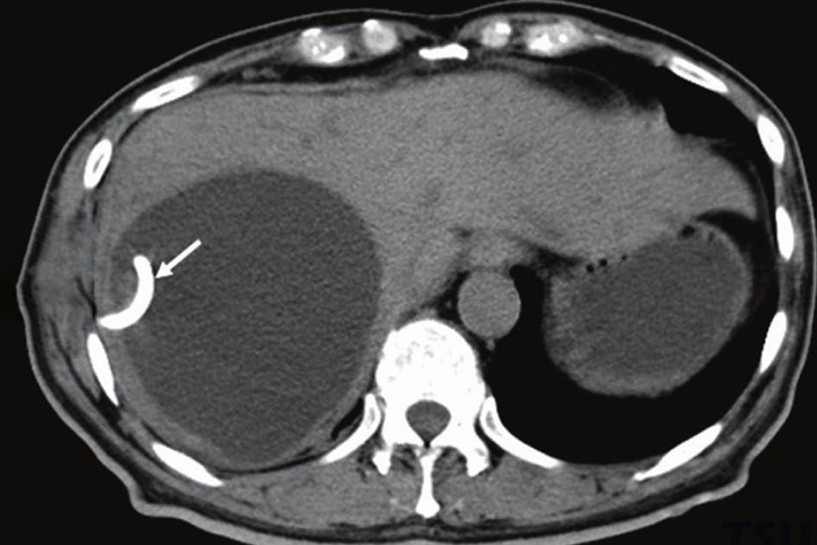 肝囊肿图 肝囊肿图
