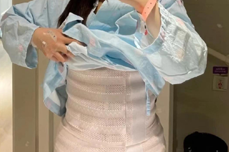 腰腹部脂肪抽吸术第1天效果图