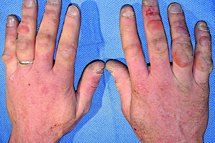 卟啉病早期皮损症状图