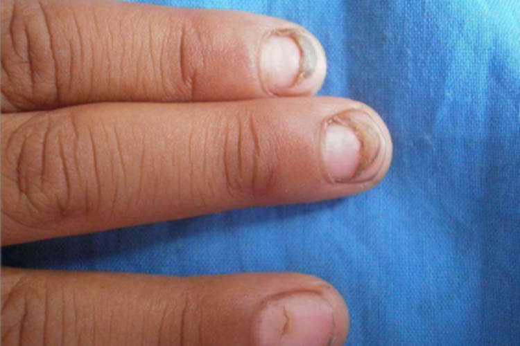 甲分离指甲翘起有血线图 甲分离指甲翘起有血线图