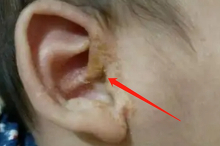 脓毒型猩红热耳周长黄痂 脓毒型猩红热耳周长黄痂