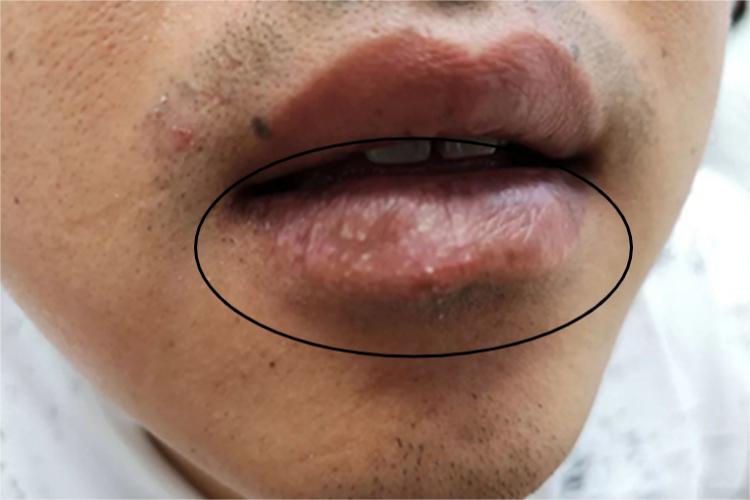 皮脂腺异位症嘴唇疙瘩图