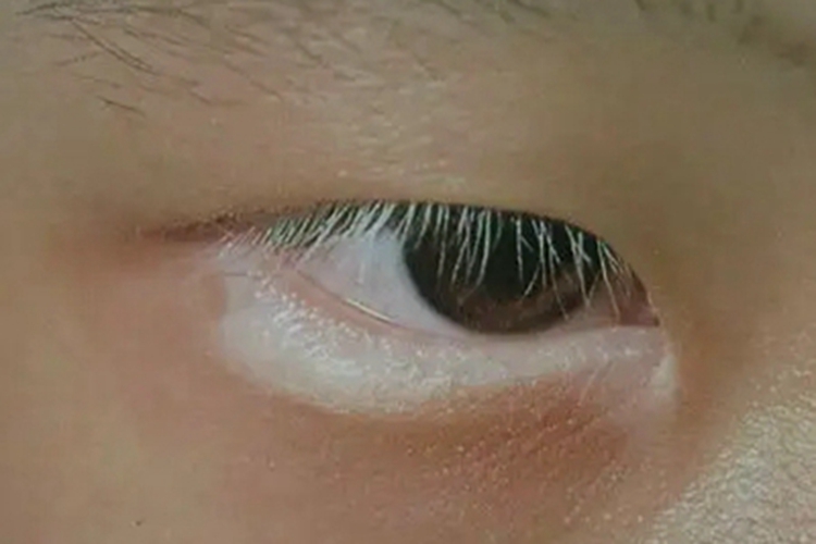 白癜风眼睑白斑图