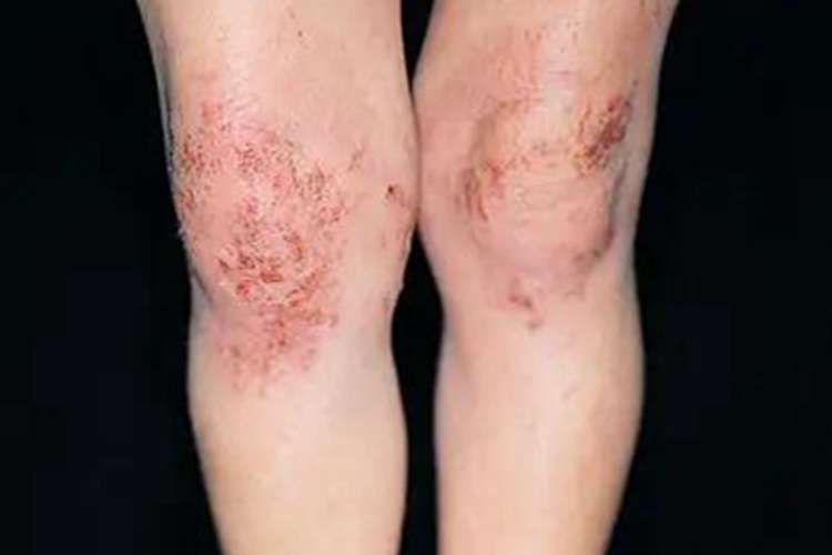 急性湿疹膝盖结痂图