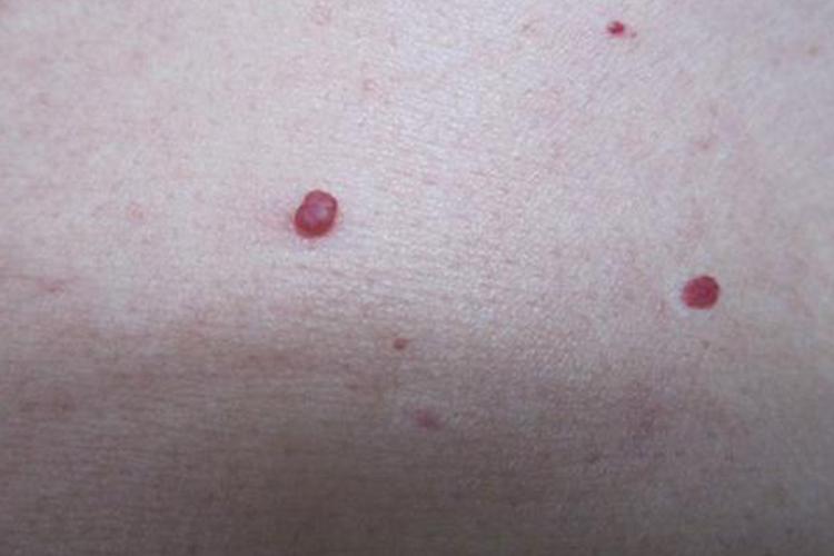 樱桃状血管瘤图 樱桃状血管瘤图