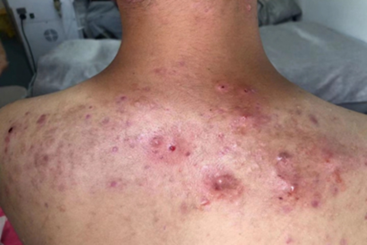 细菌性毛囊炎背部脓疱图