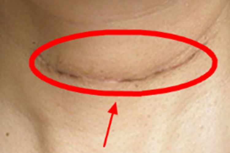 开放式甲状腺手术一个月后伤口图 开放式甲状腺手术一个月后伤口图