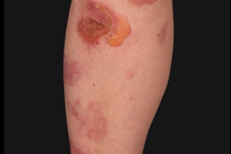 大疱性表皮松解症小腿水疱图 大疱性表皮松解症小腿水疱图