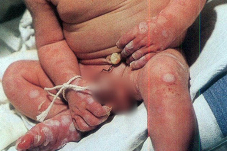 先天性梅毒全身脱屑图 先天性梅毒全身脱屑图