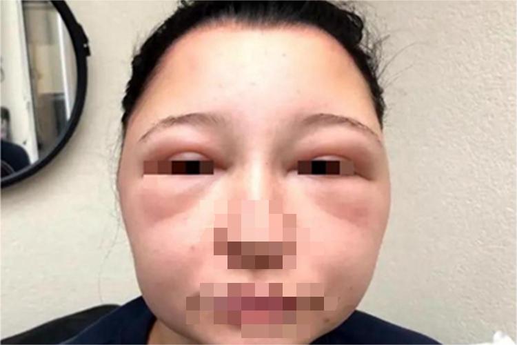 皮肤过敏红肿面部肿图 皮肤过敏红肿面部肿图