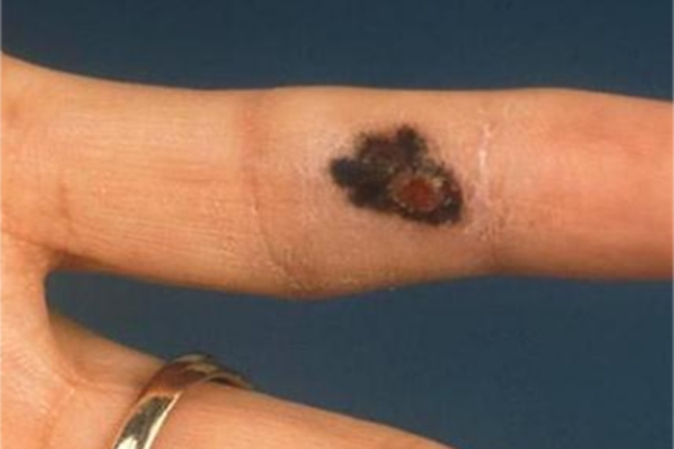 恶性雀斑样痣手指黑斑图