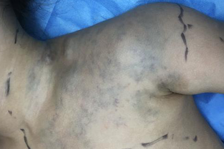 肩颈部静脉血管畸形图