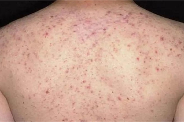 痤疮背部有很多黑头图 痤疮背部有很多黑头图