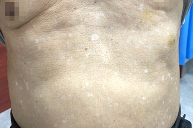 老年性白斑腹部白斑图