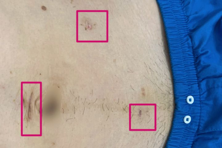 腹腔镜阑尾切除术瘢痕图 腹腔镜阑尾切除术瘢痕图