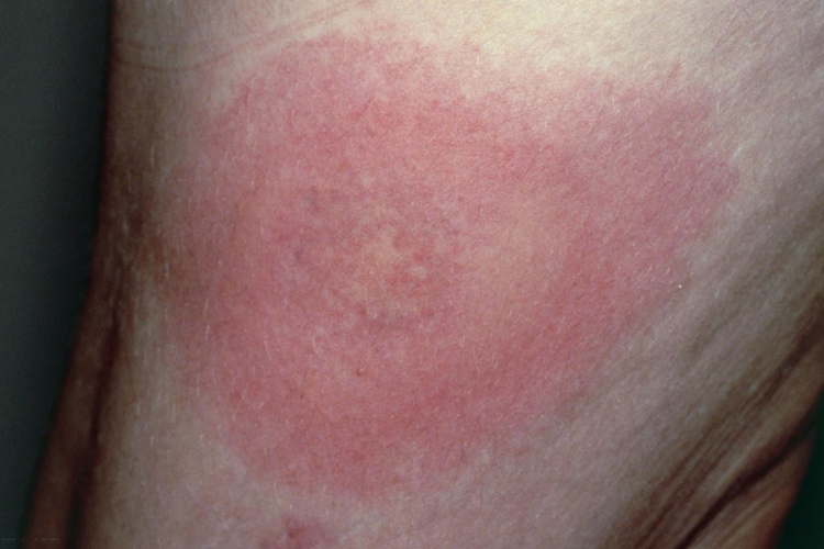 游走性红斑图