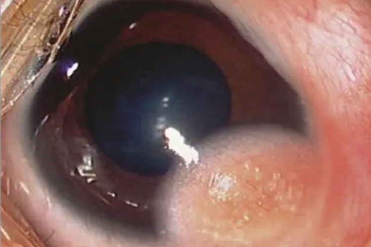 角膜皮样瘤角膜症状图 角膜皮样瘤角膜症状图